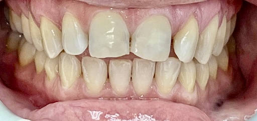 Crowded teeth before